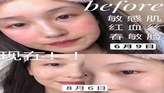 红血丝